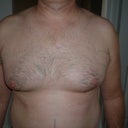 CHEST DAY AFTER MPX SMART LIPO